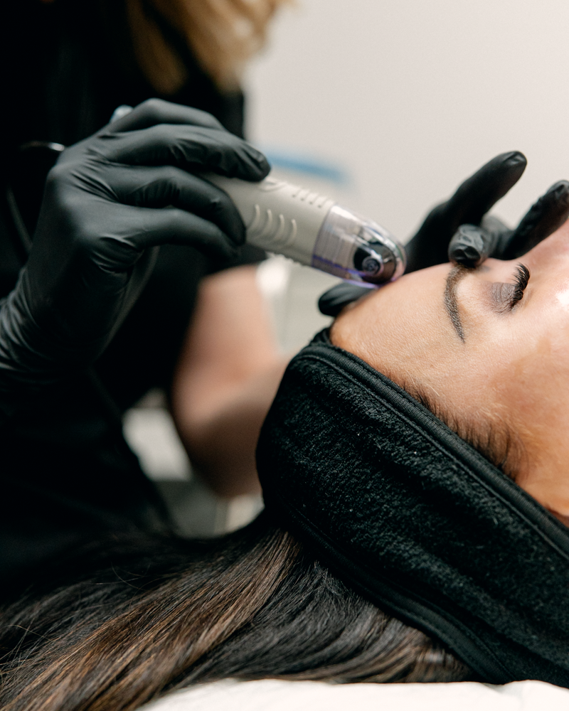 DermaFrac (Vampire Facial) Package of 2 Treatments