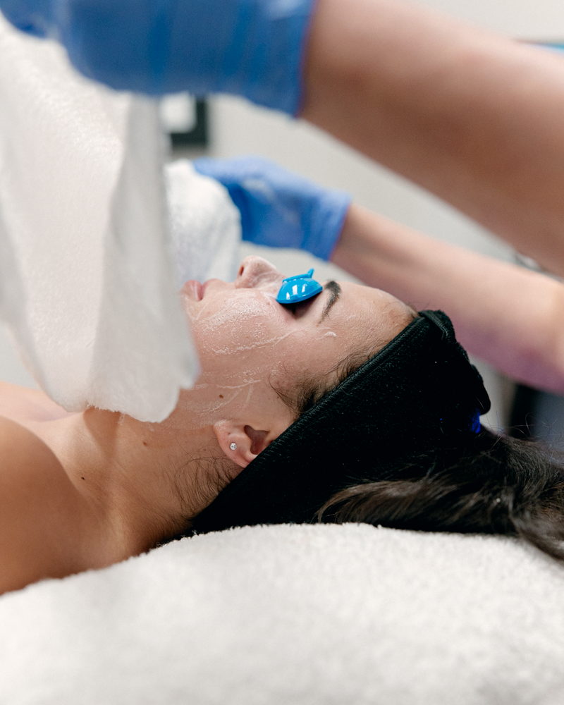Trichloroacetic Acid (TCA) Peel Single Treatment
