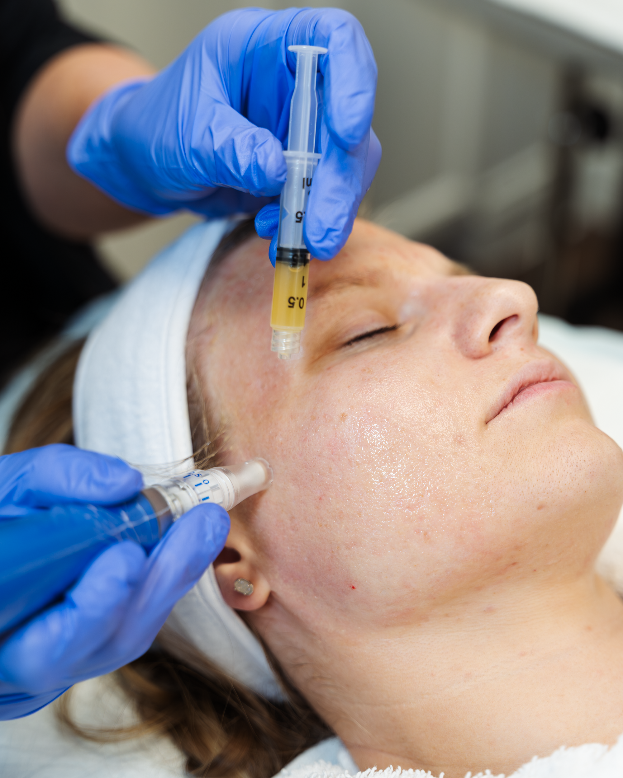 SkinPen with PRP Package of 2 Treatments