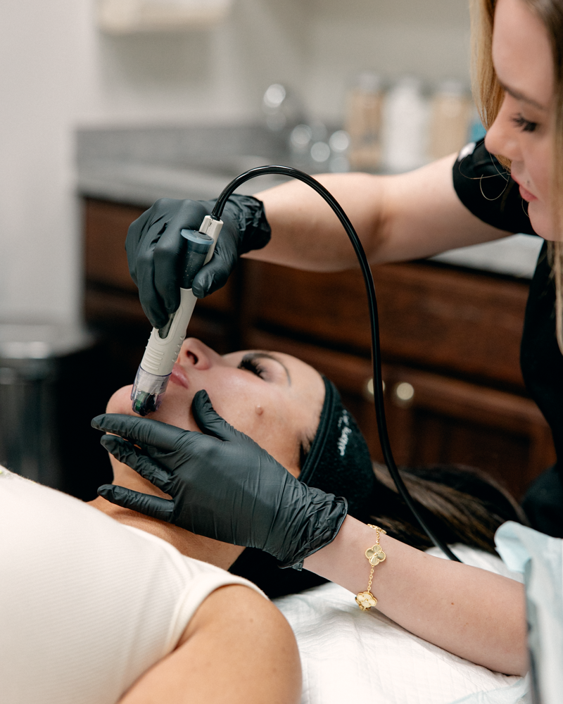 DermaFrac (Vampire Facial) Single Treatment
