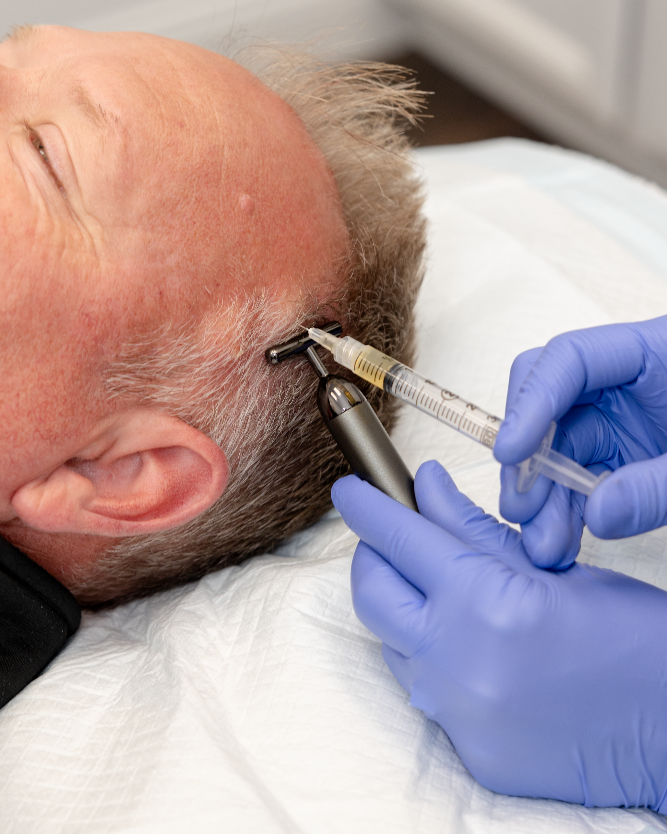 PRP Hair Restoration Single Treatment