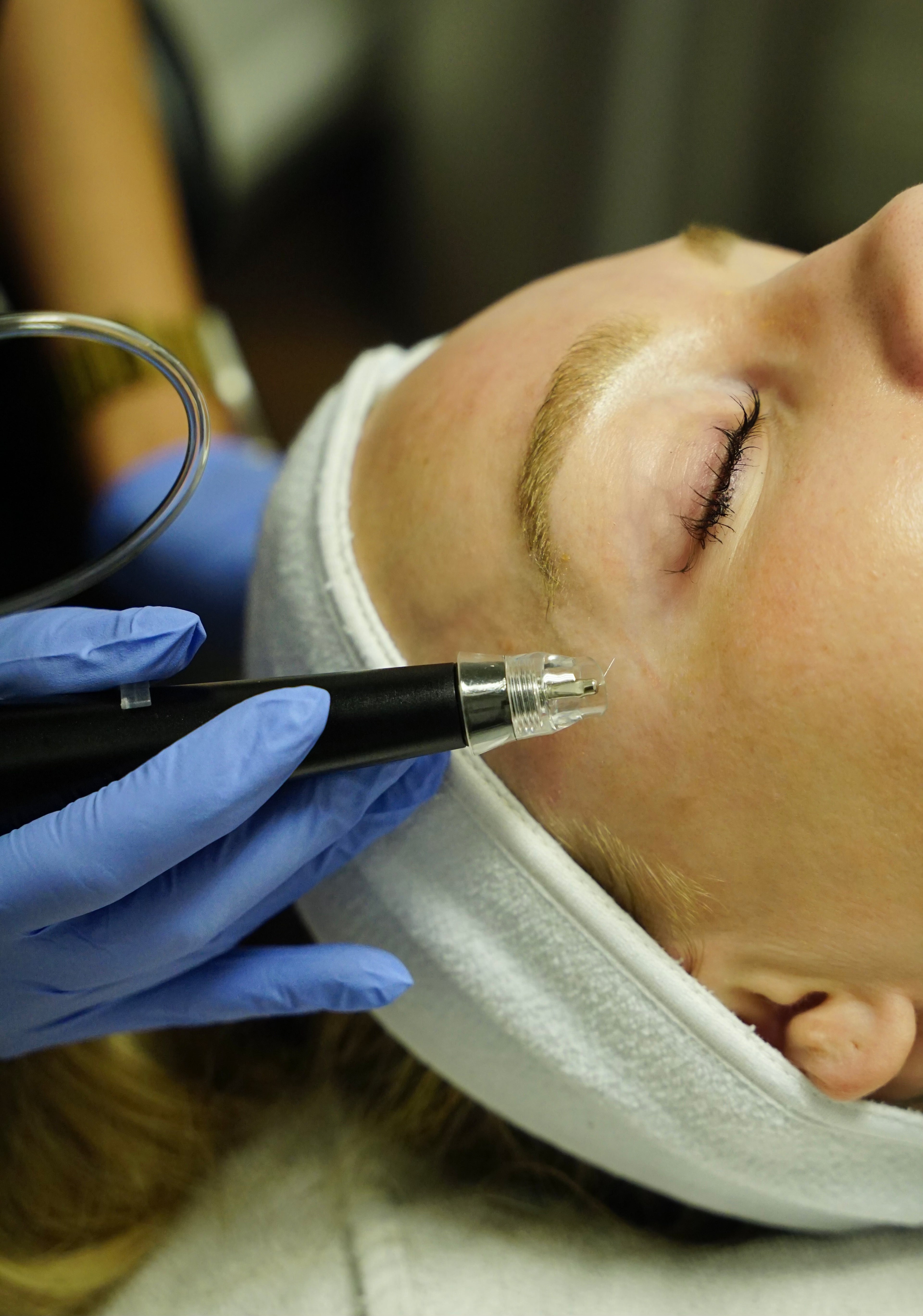 Plasma Pen Upper or Lower Eyelids