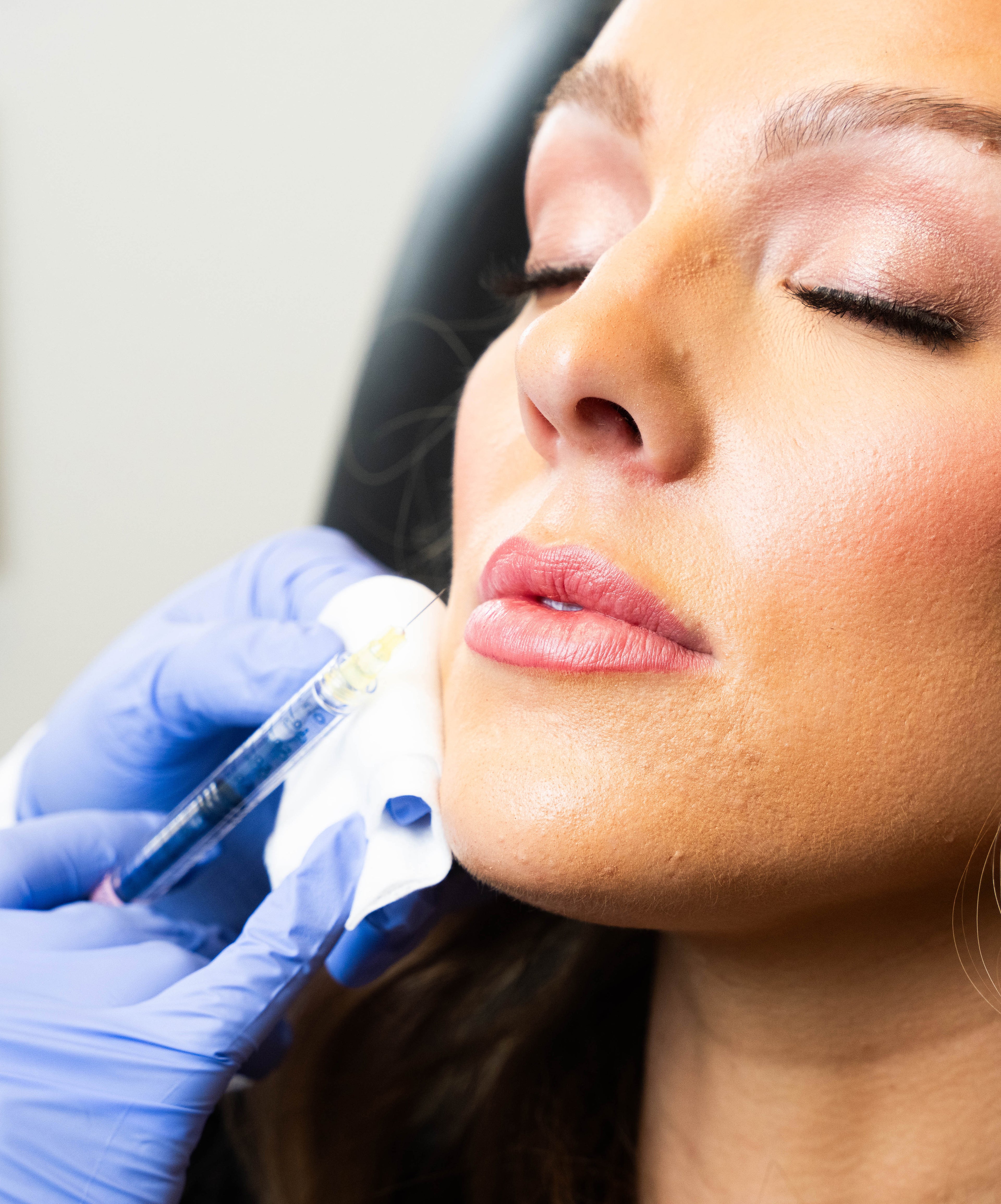 Radiesse Cheek Hollowing/ Preauriculars