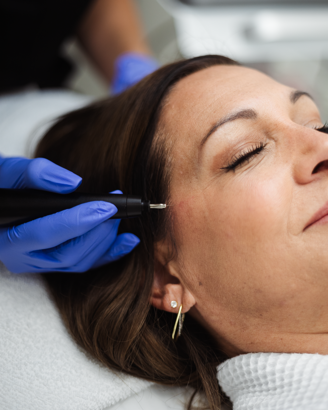 Plasma Pen Upper or Lower Eyelids Package of 2 Treatments
