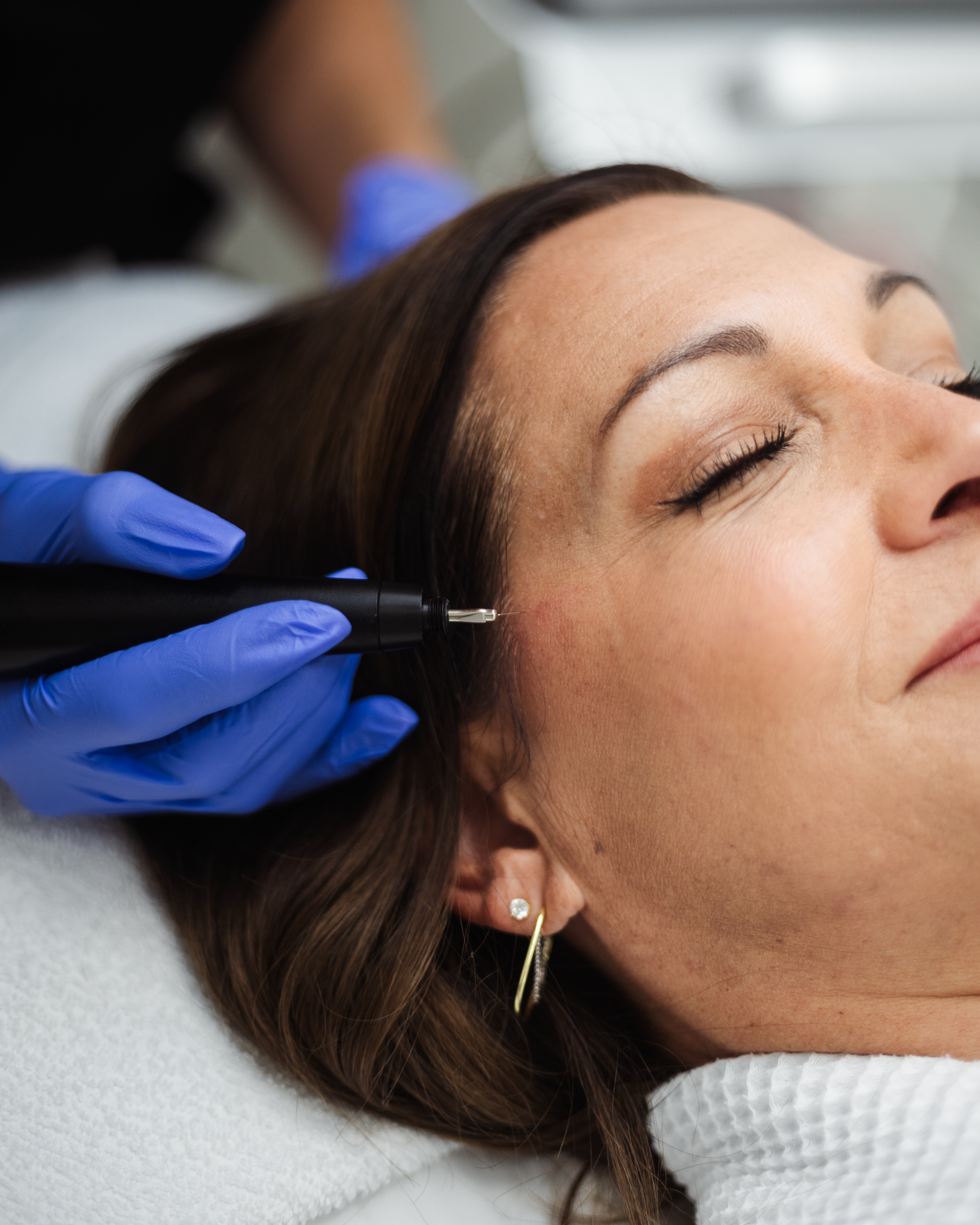 Plasma Pen Upper or Lower Eyelids Package of 2 Treatments