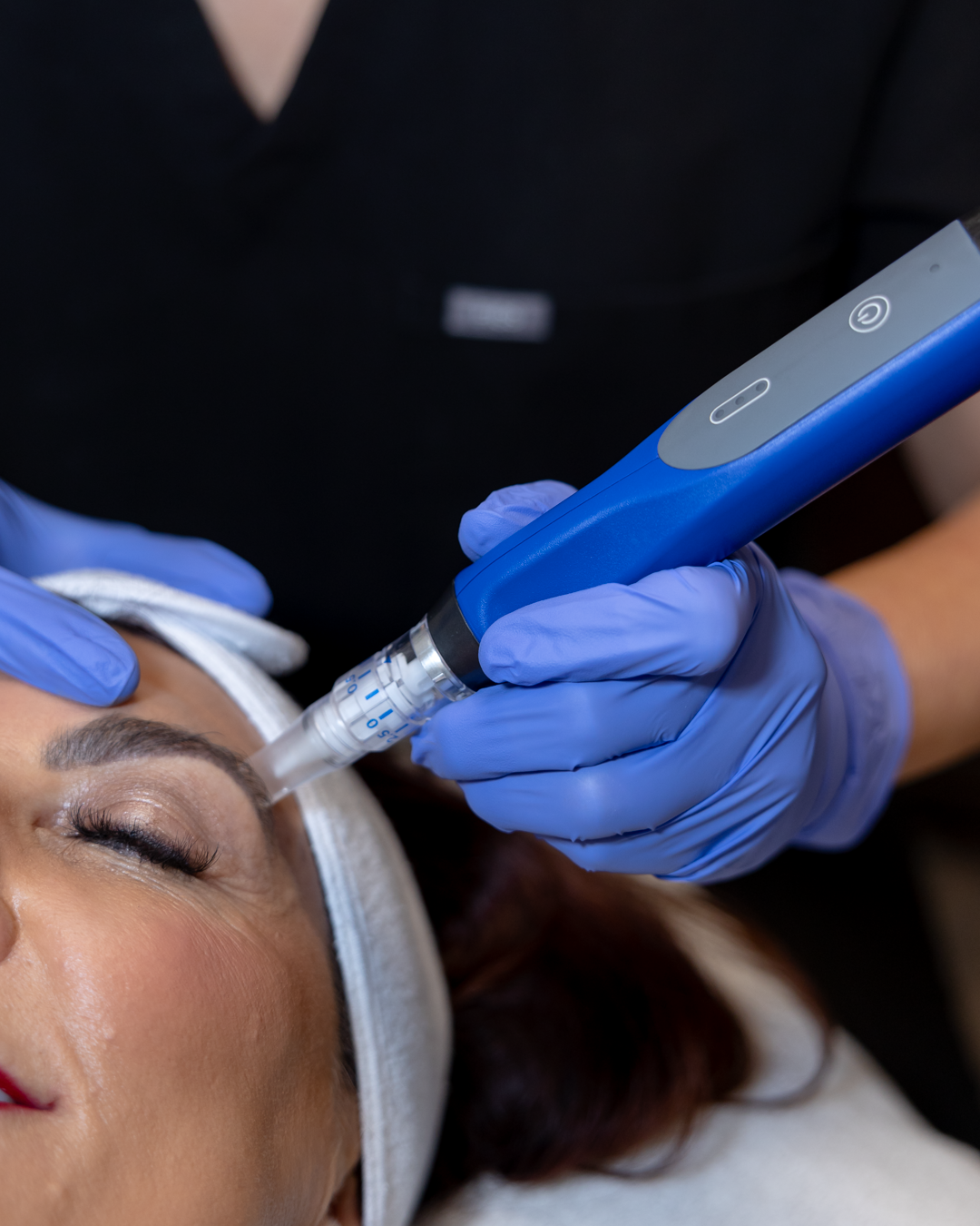SkinPen with PRP Package of 3 Treatments
