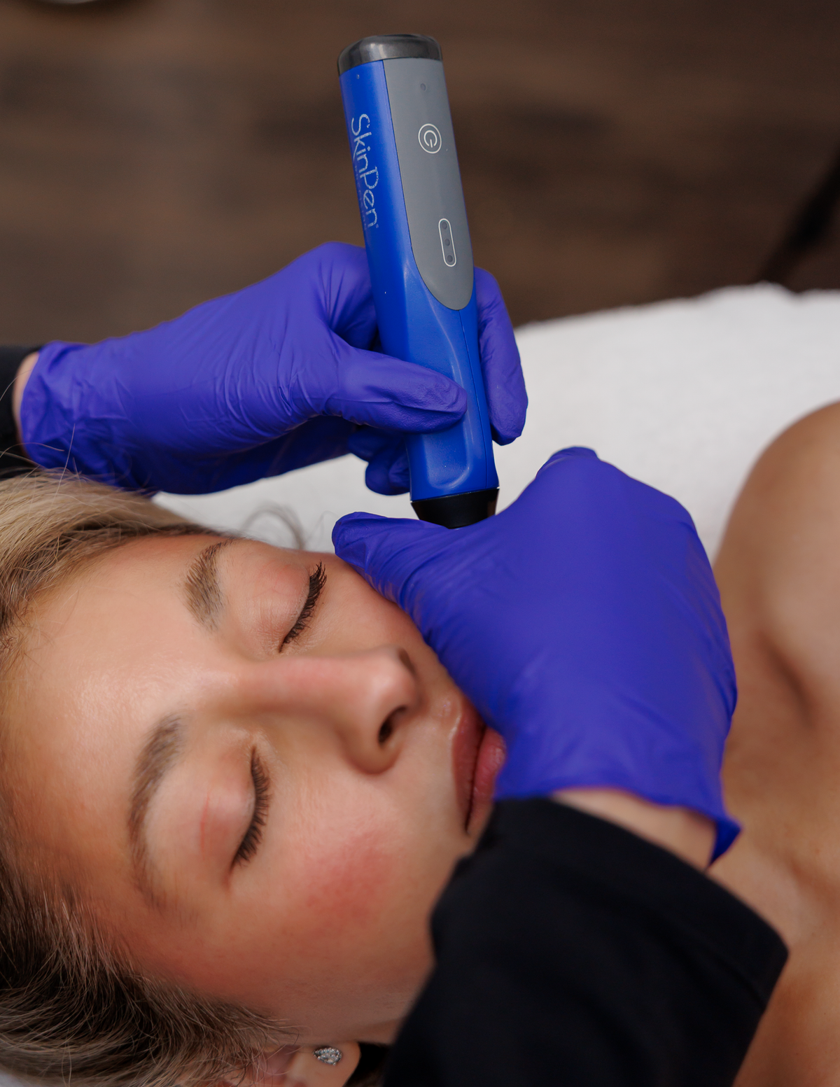 Regenerative Microneedling (SkinPen with PDGF): Single Session