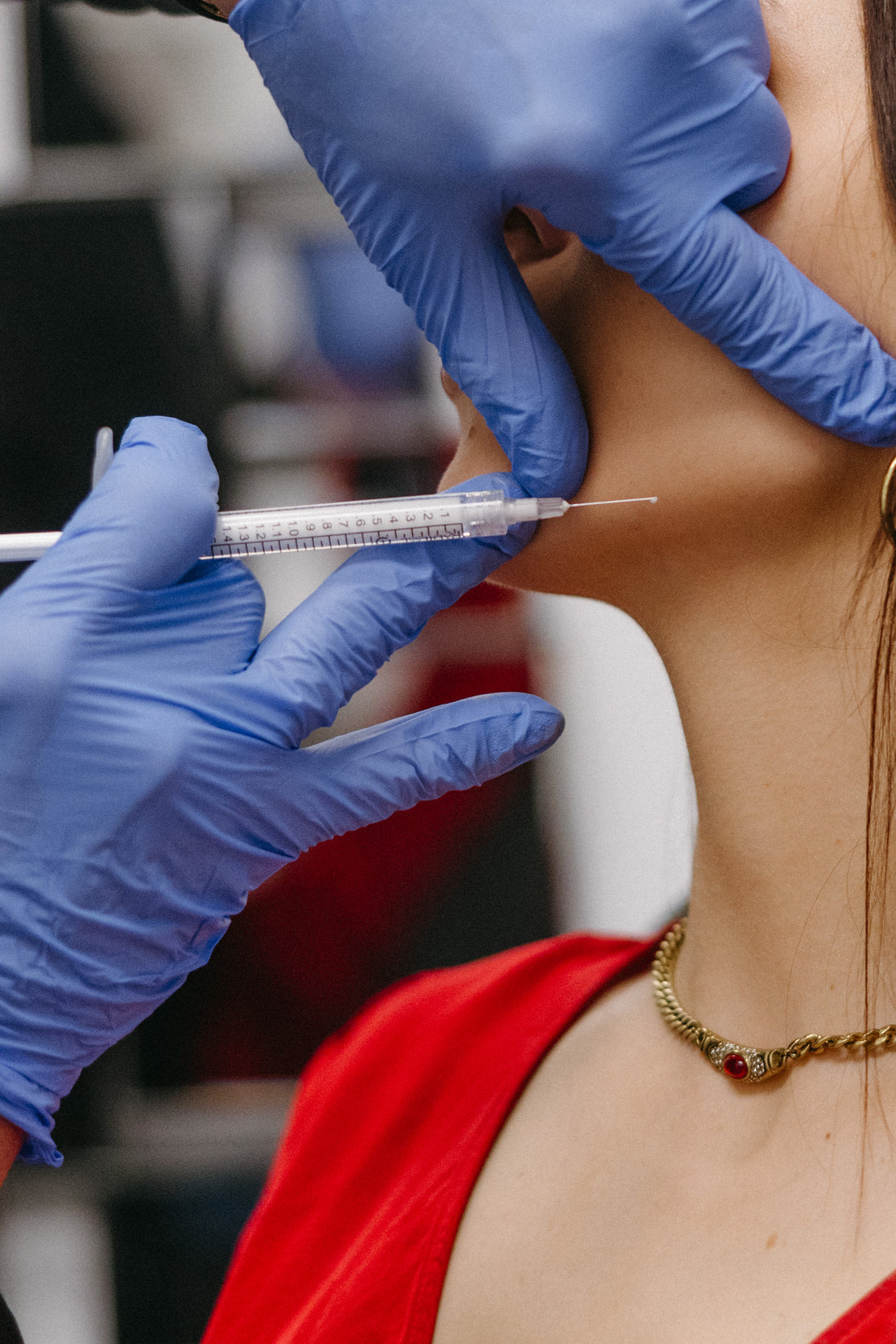 Radiesse Neck Rejuvenation