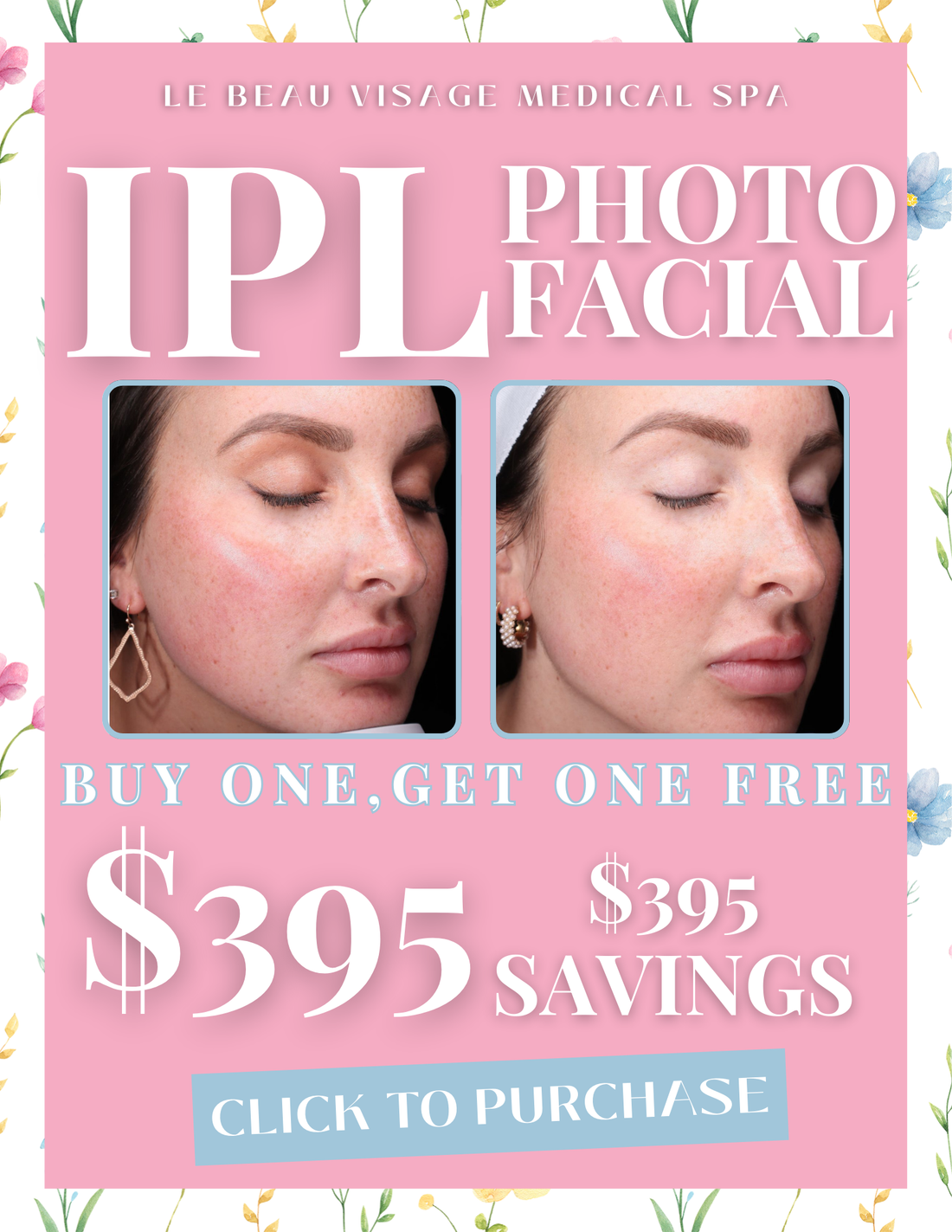 IPL PhotoFacial - BOGO
