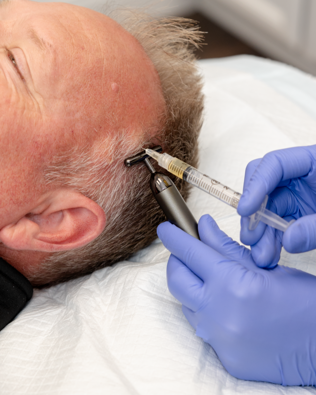 PRP Hair Restoration Single Treatment