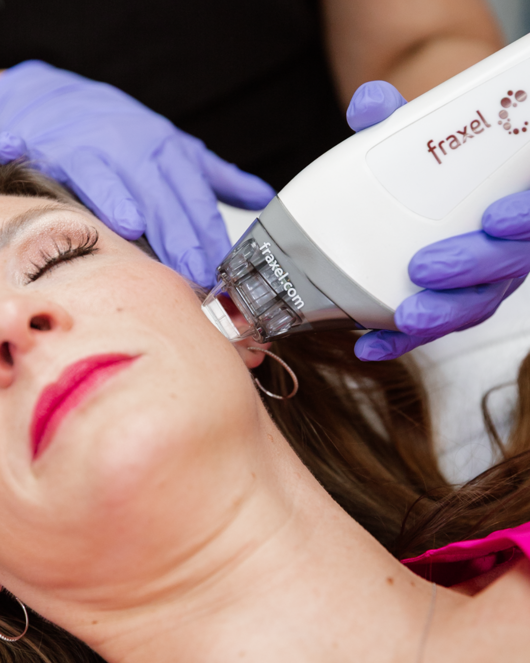 Fraxel Single Treatment