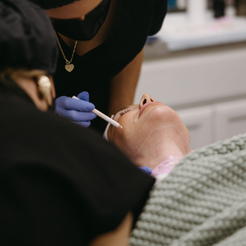 Plasma Pen (Peri Oral) Single Treatment